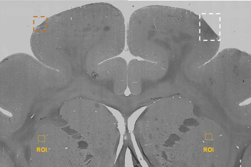 Actuated Medical's TubeClear control box and Stem